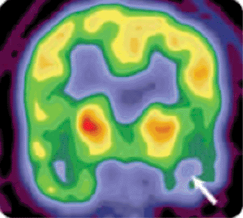 Imagen: Una tomografía de emisión de positrones (PET) del cerebro de un paciente con epilepsia (Fotografía cortesía del Hospítal Infantil de Seattle).